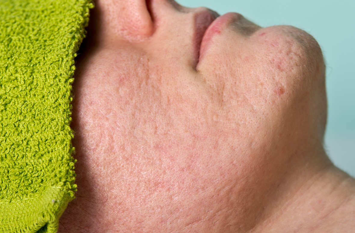 Acne Acne Scar