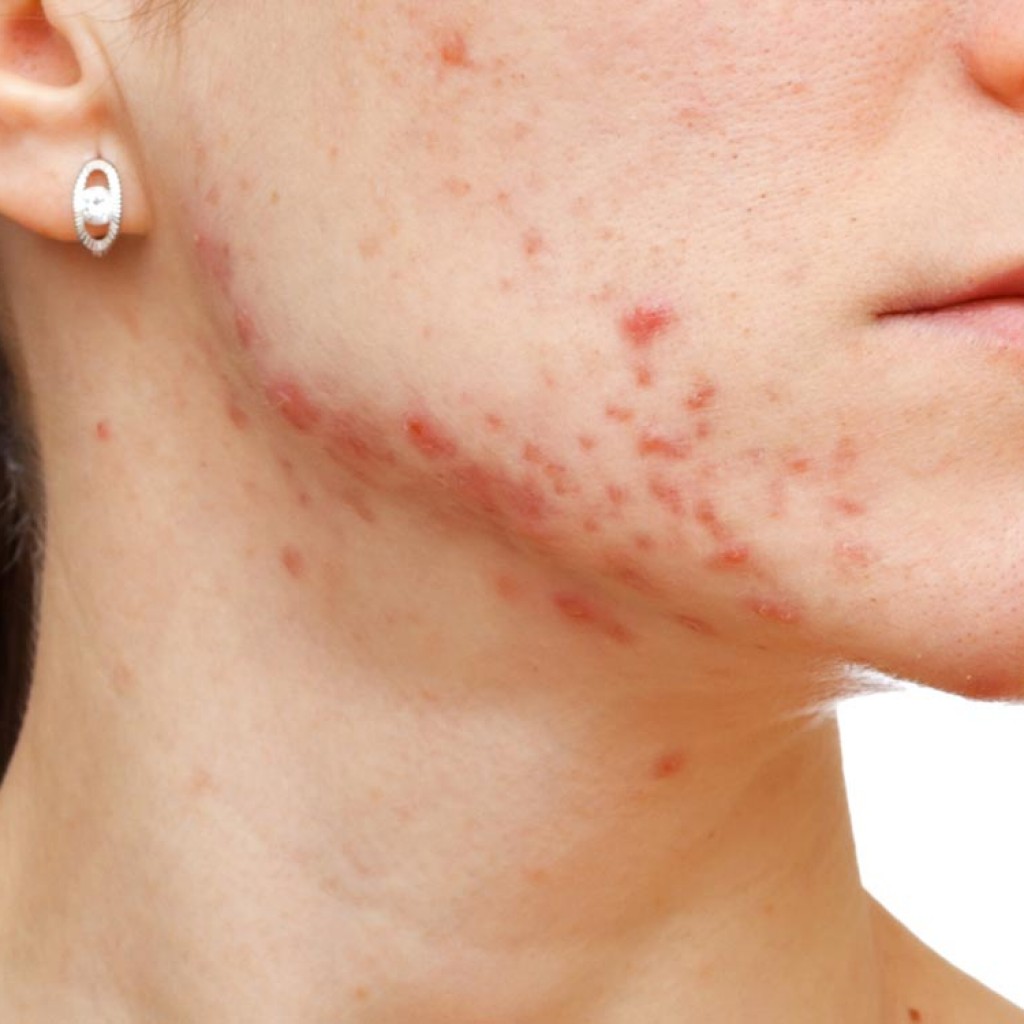 AcneNoMore2