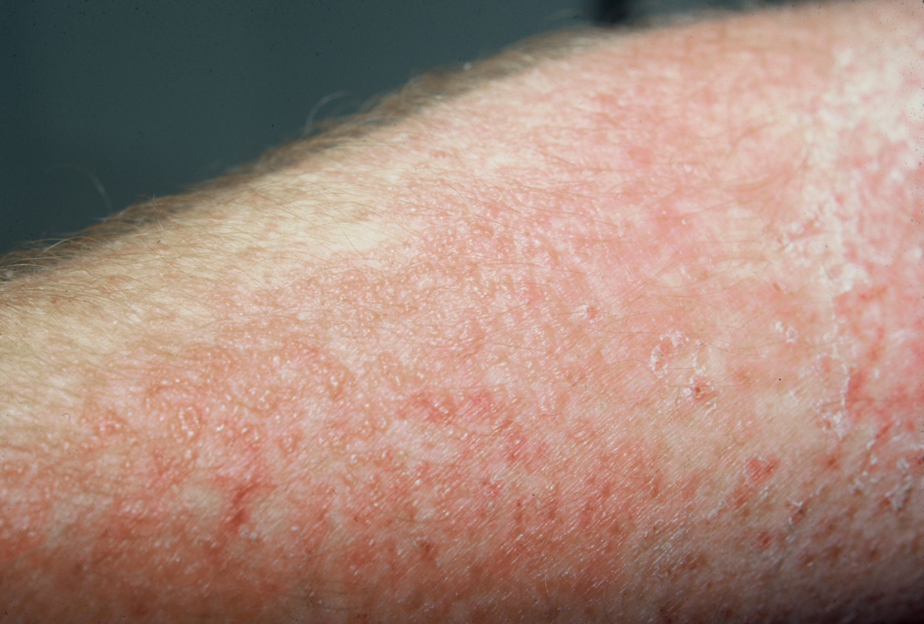 Allergic Contact Dermatitis Treatment23