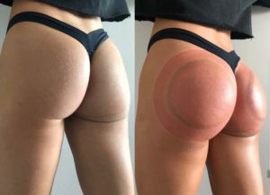 Buttock Lift Treatment1