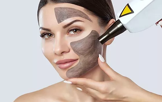 Carbon laser peel1