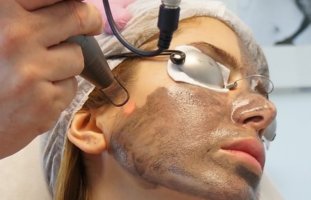 Carbon laser peel2