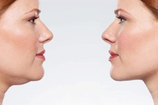 Double Chin Treatment1