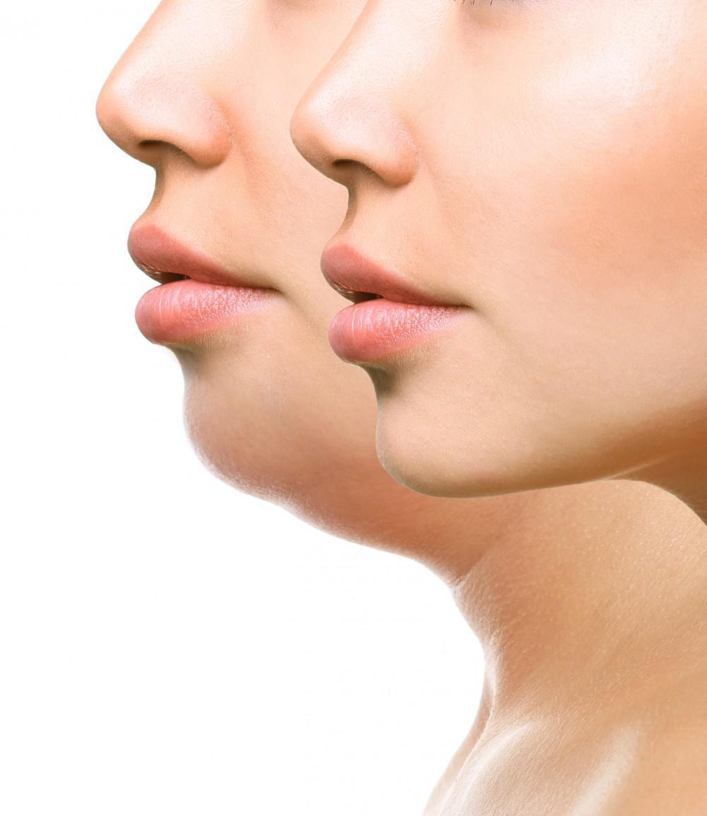 Double Chin Treatment2
