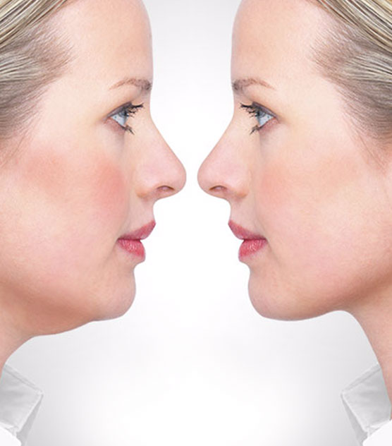 Double Chin Treatment3