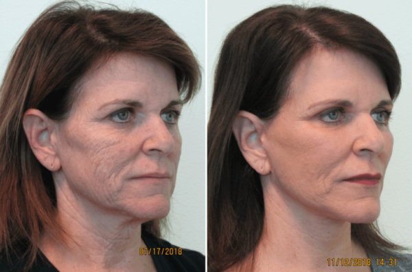 FRACTIONAL CO2 TREATMENTS1