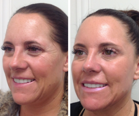 FRACTIONAL CO2 TREATMENTS23