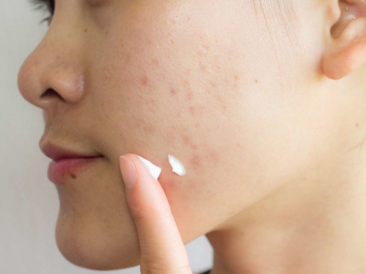 Freckles and Blemishes3