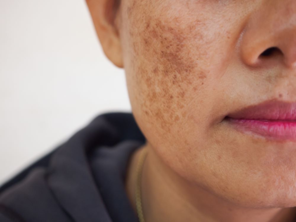 Freckles and Blemishes