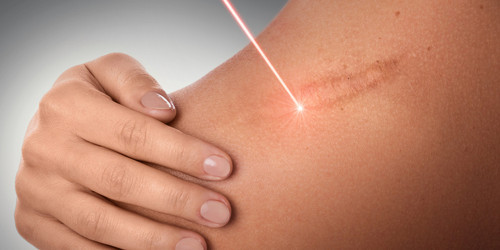 Keloids Treatment1