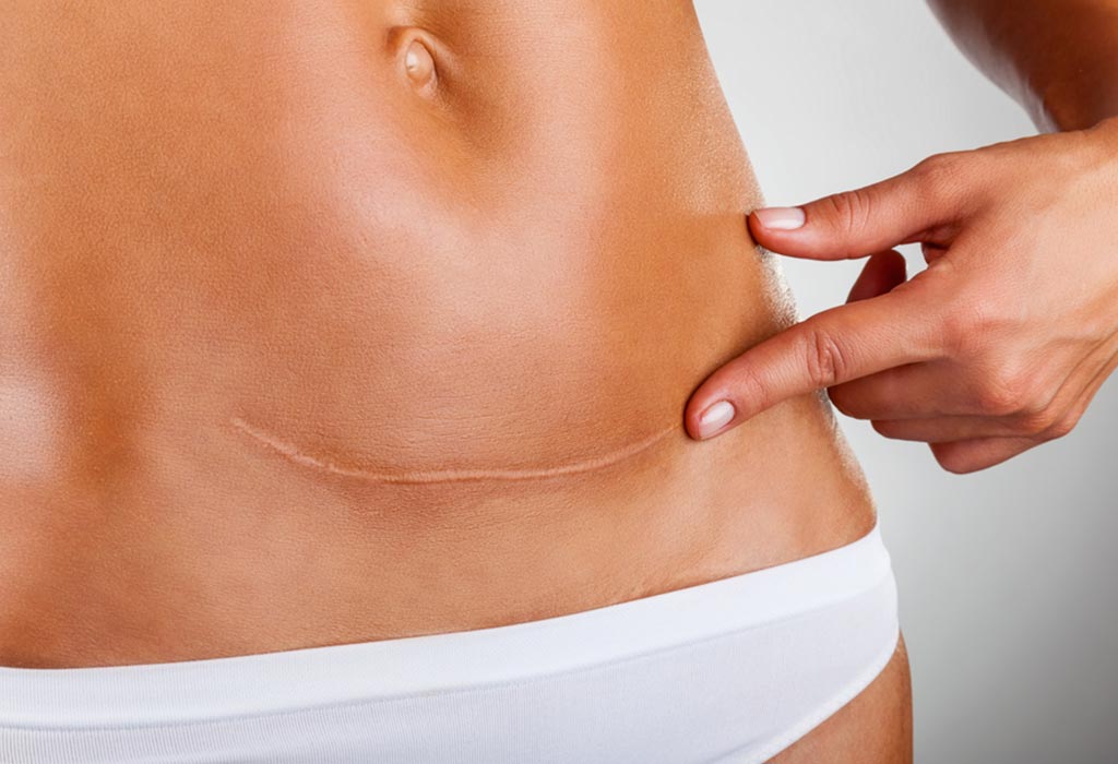 Keloids Treatment3