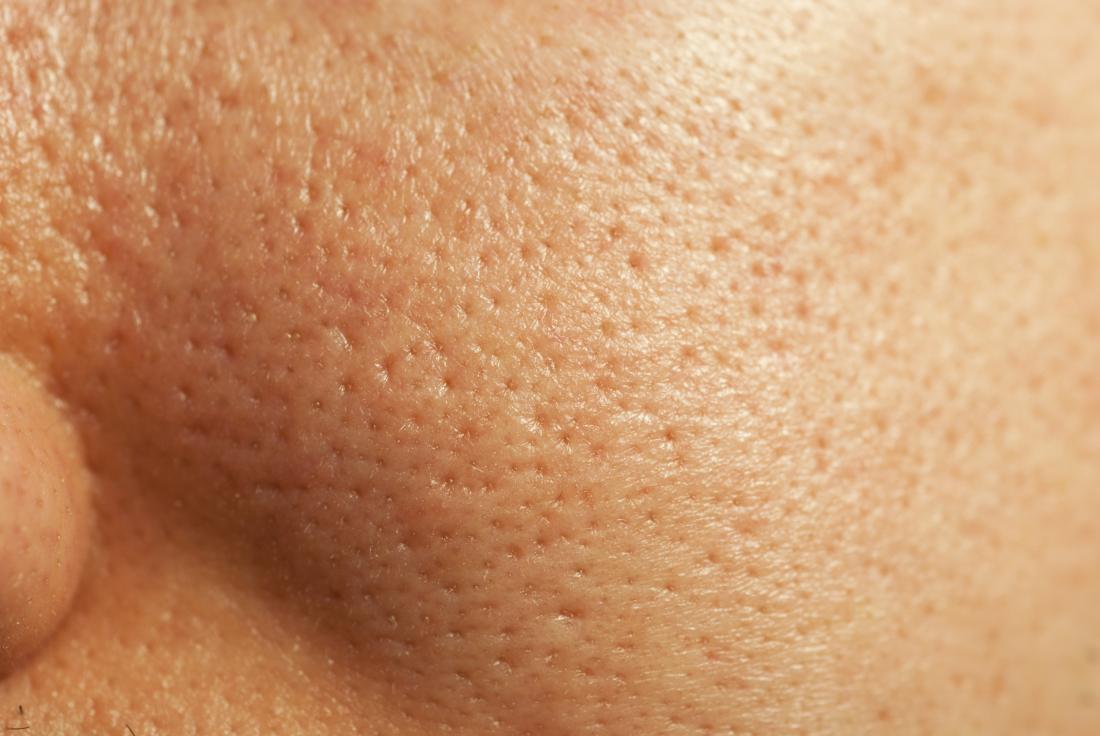 LARGE PORES TREATMENT