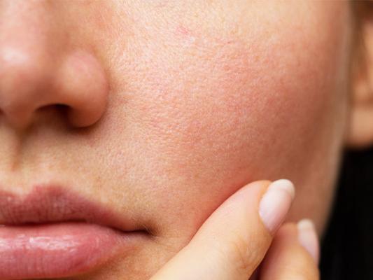 LARGE PORES TREATMENT2