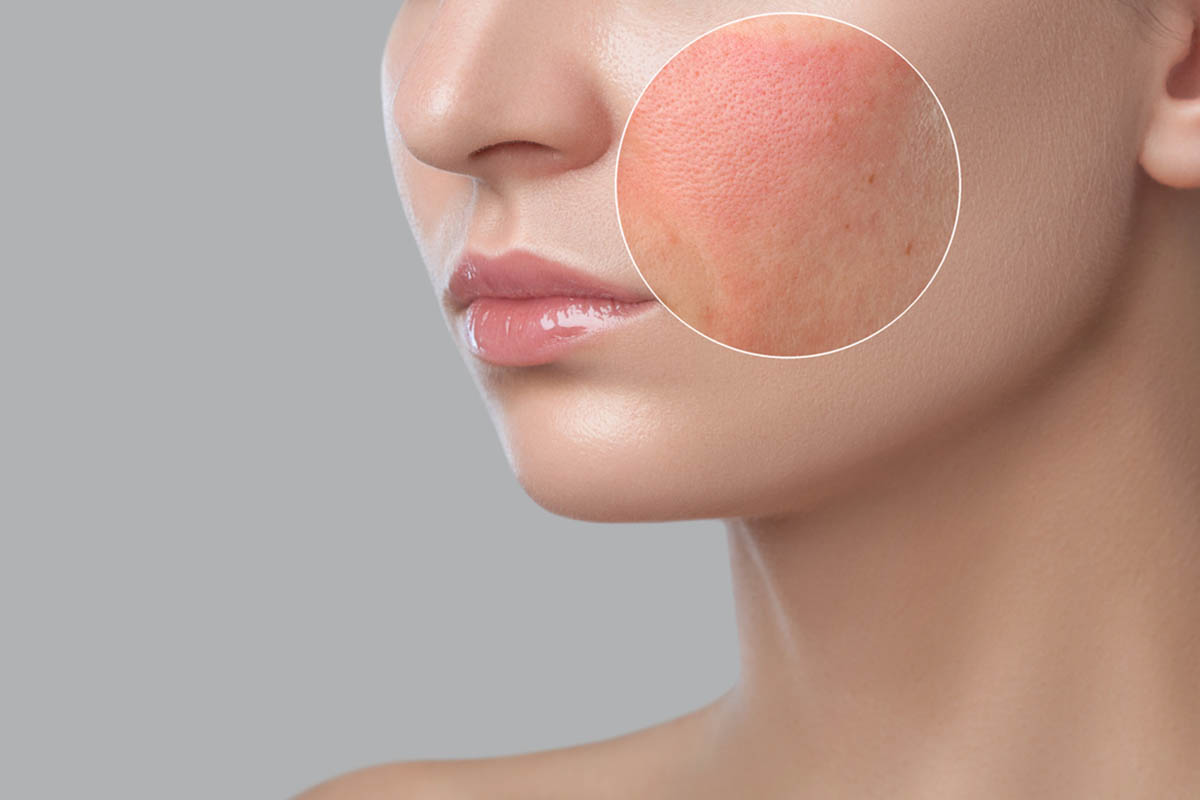 LARGE PORES TREATMENT3