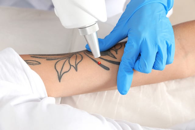 LASER TATTOO REMOVAL TREATMENT1