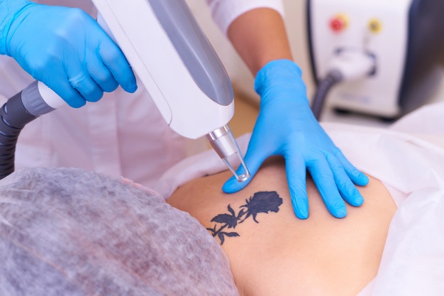 LASER TATTOO REMOVAL TREATMENT2