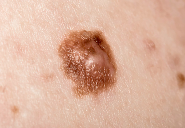 MOLES AND MELANOMA1