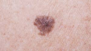 MOLES AND MELANOMA2