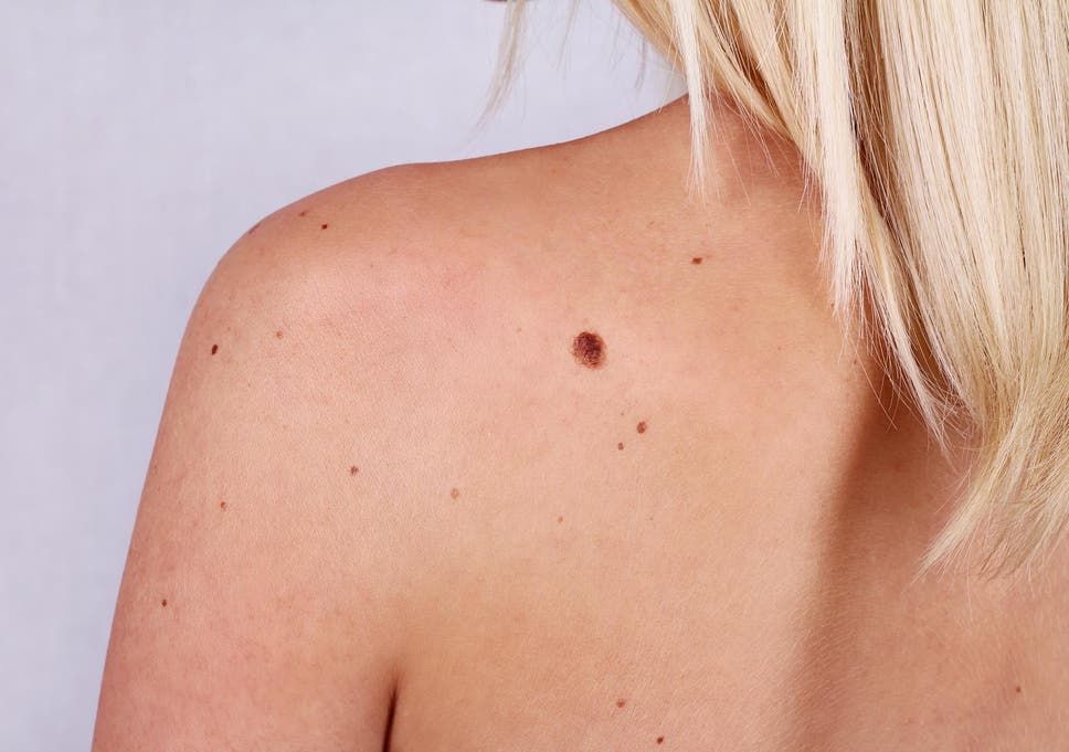 MOLES AND MELANOMA3
