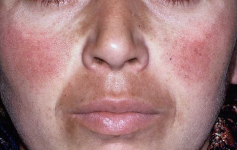 Melasma Treatment1