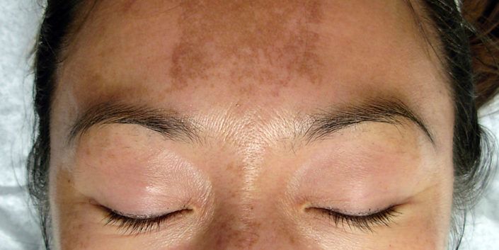 Melasma Treatment3
