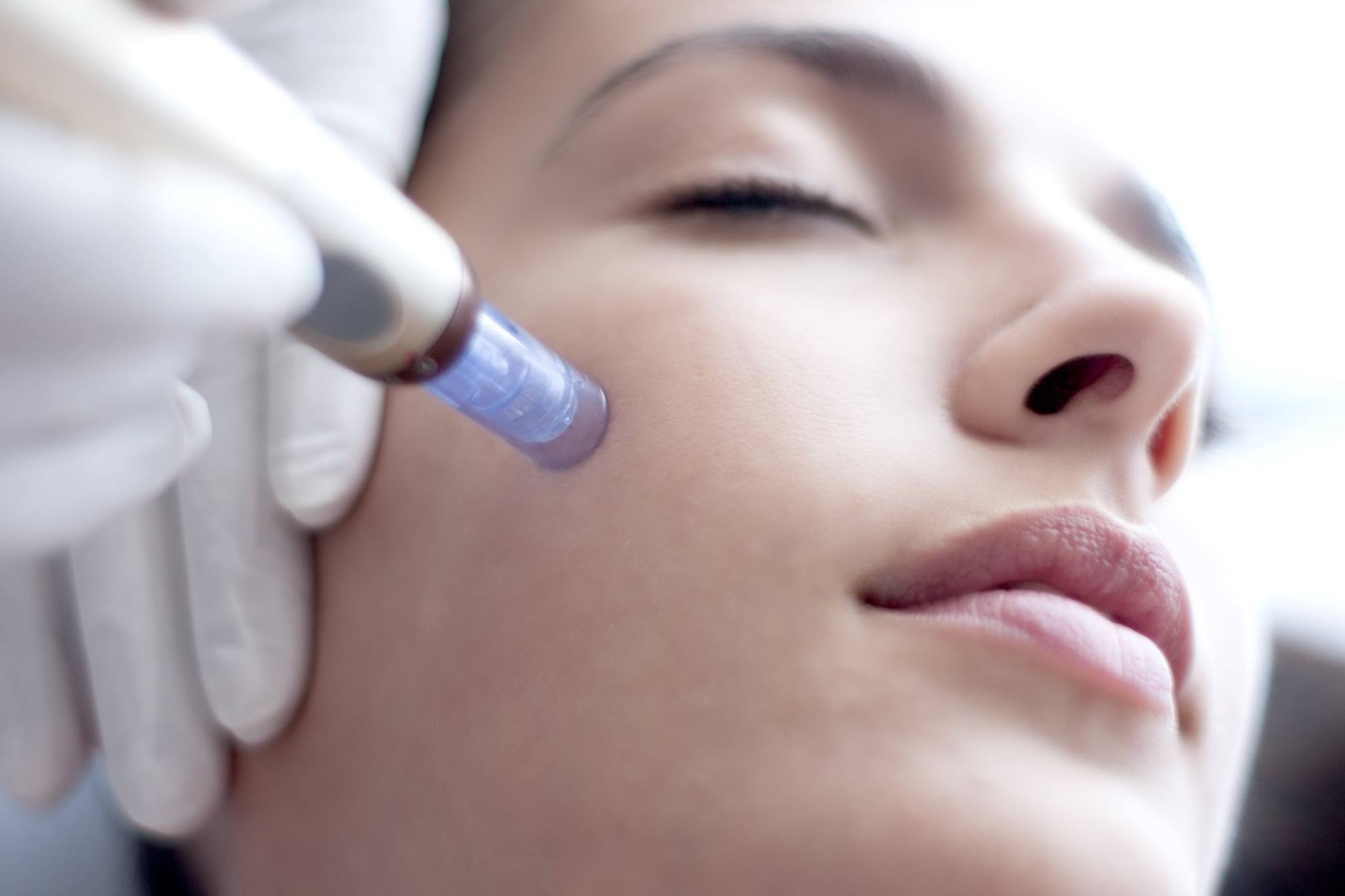 Mesotherapy Treatment2