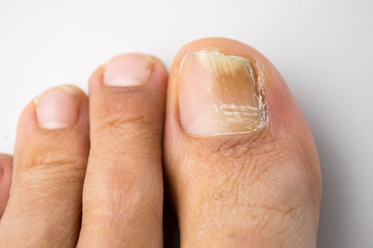 Nail disorders Treatment1