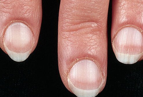 Nail disorders Treatment2
