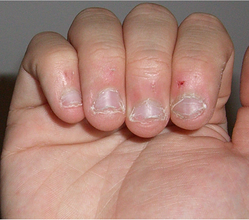 Nail disorders Treatment3