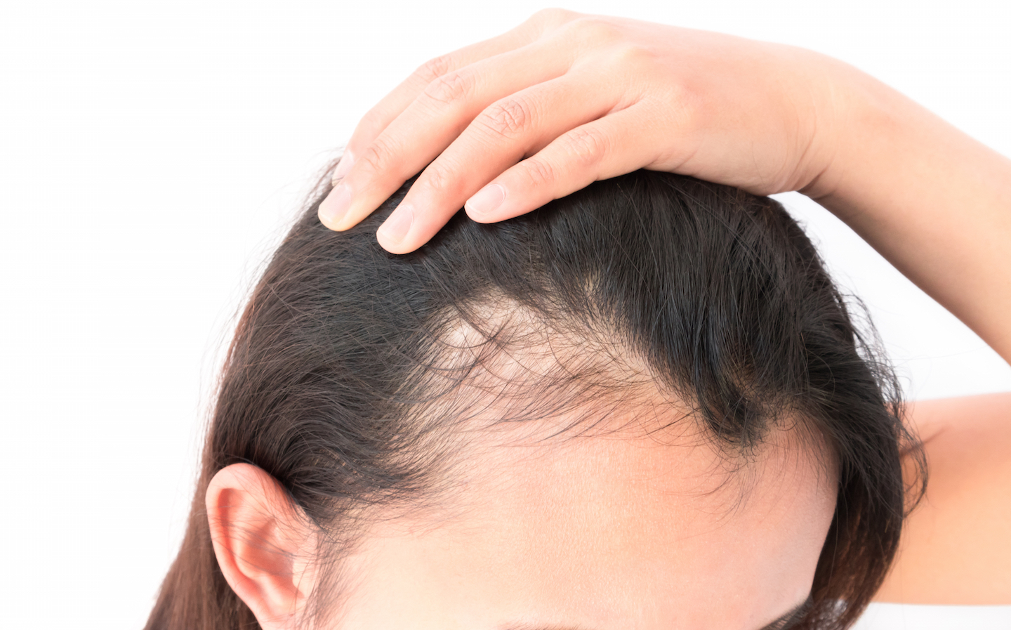 PRP for Hair loss1