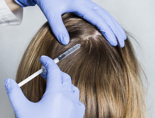 PRP for Hair loss2
