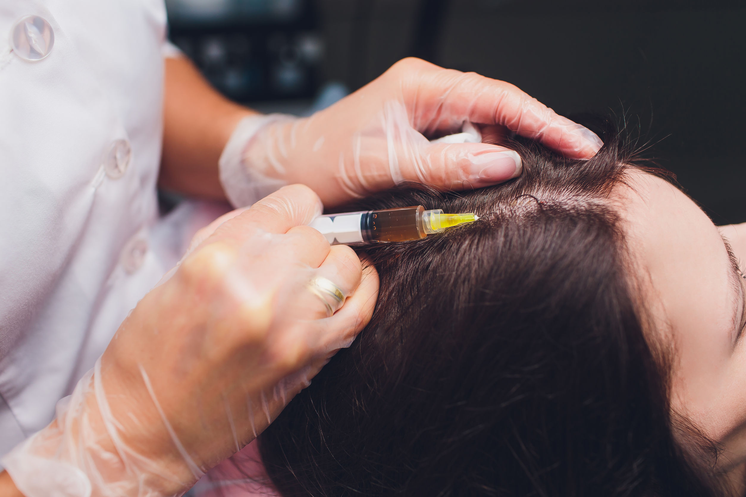 PRP for Hair loss3