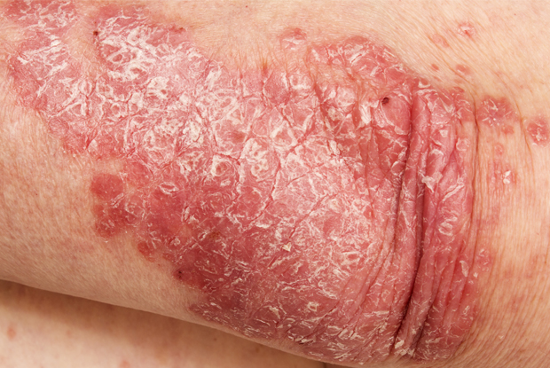 PSORIASIS1
