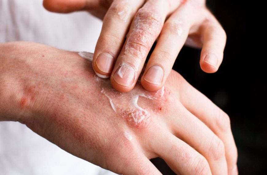 PSORIASIS2