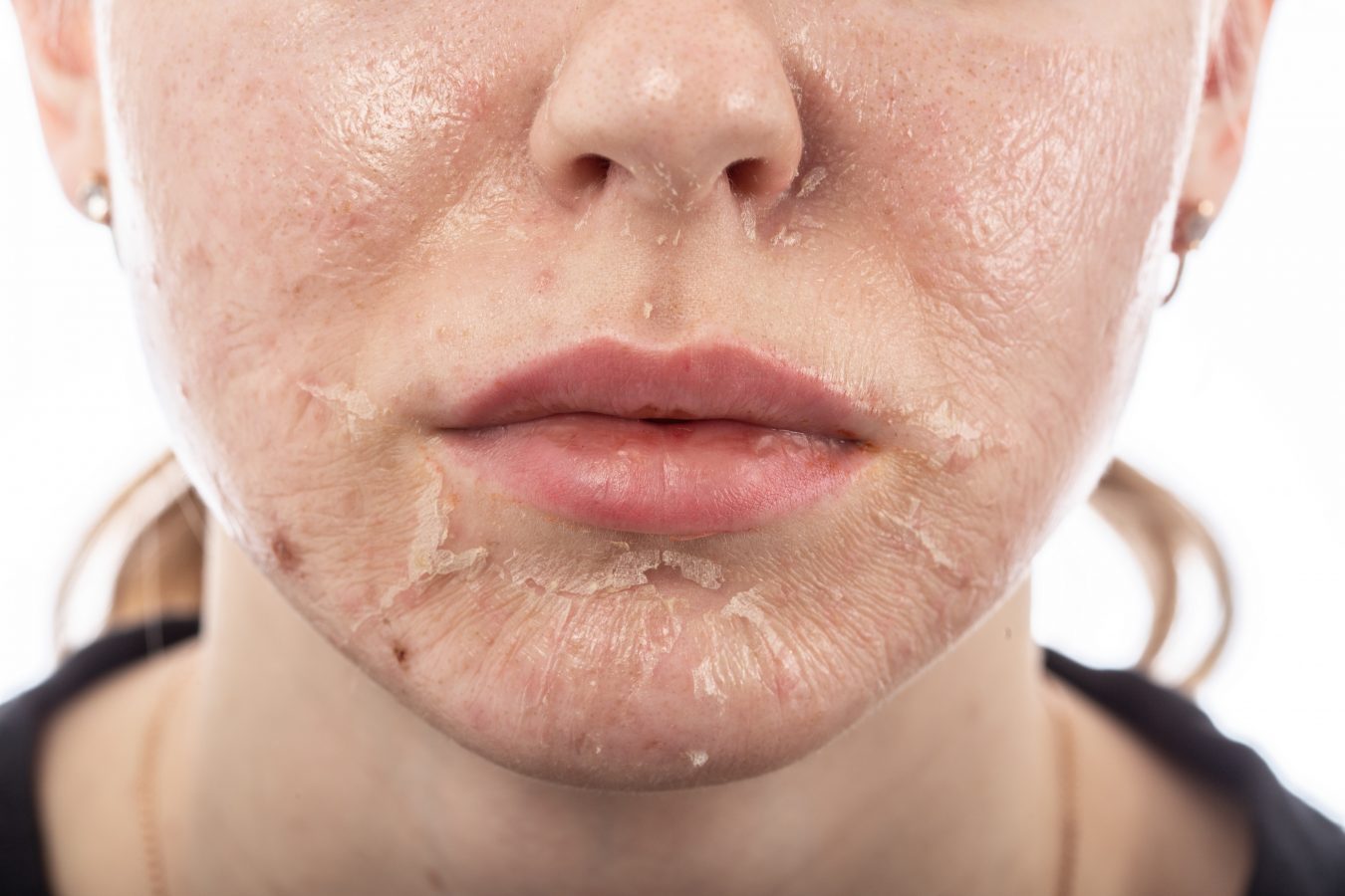 Peeling skin
