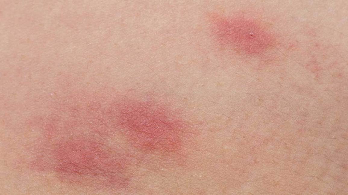 RASHES1