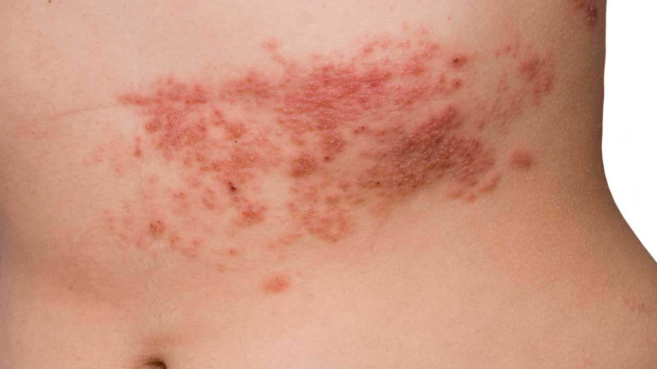 RASHES3