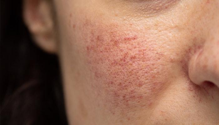 Rosacea Treatment1
