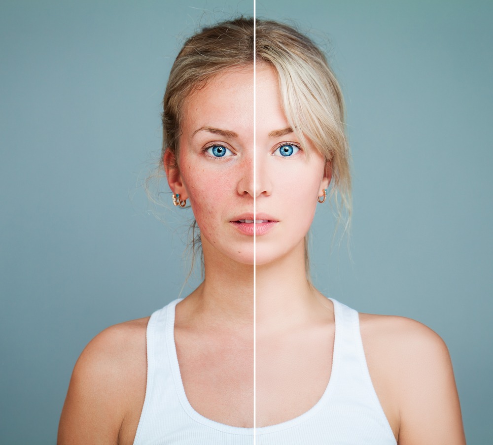 Rosacea Treatment2