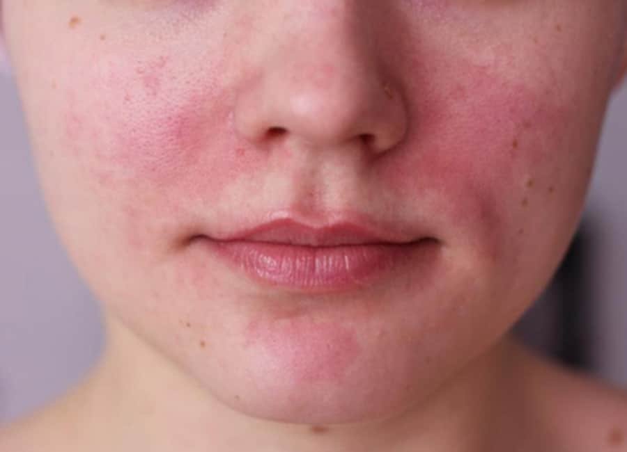 Rosacea Treatment3