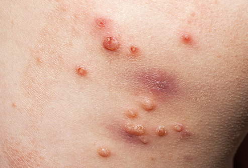 Skin Infection Treatment1
