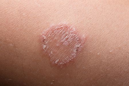 Skin Infection Treatment2