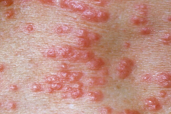 Skin Infection Treatment3