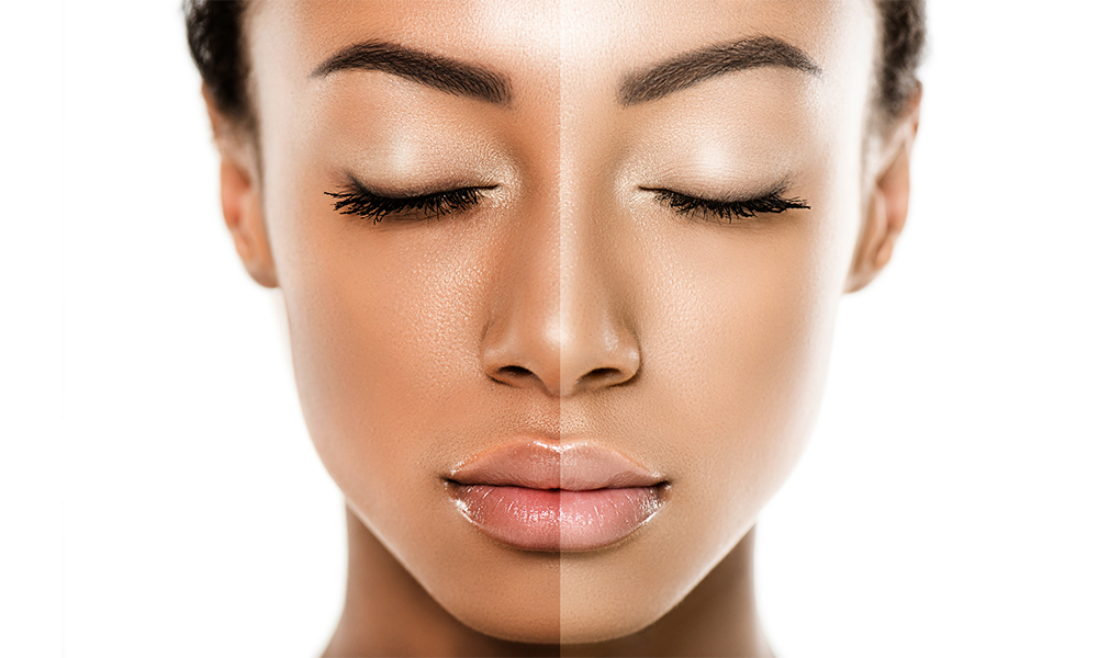 Skin Whitening Treatment2