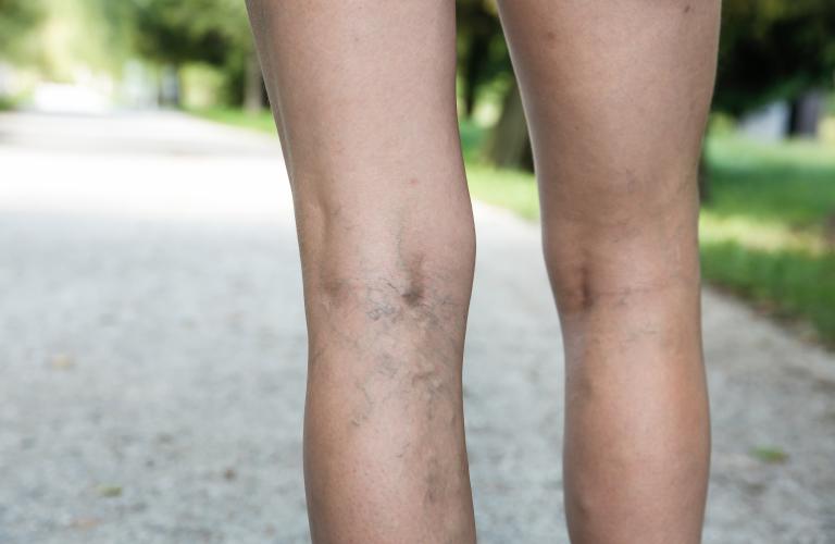 Spider vein treatment1