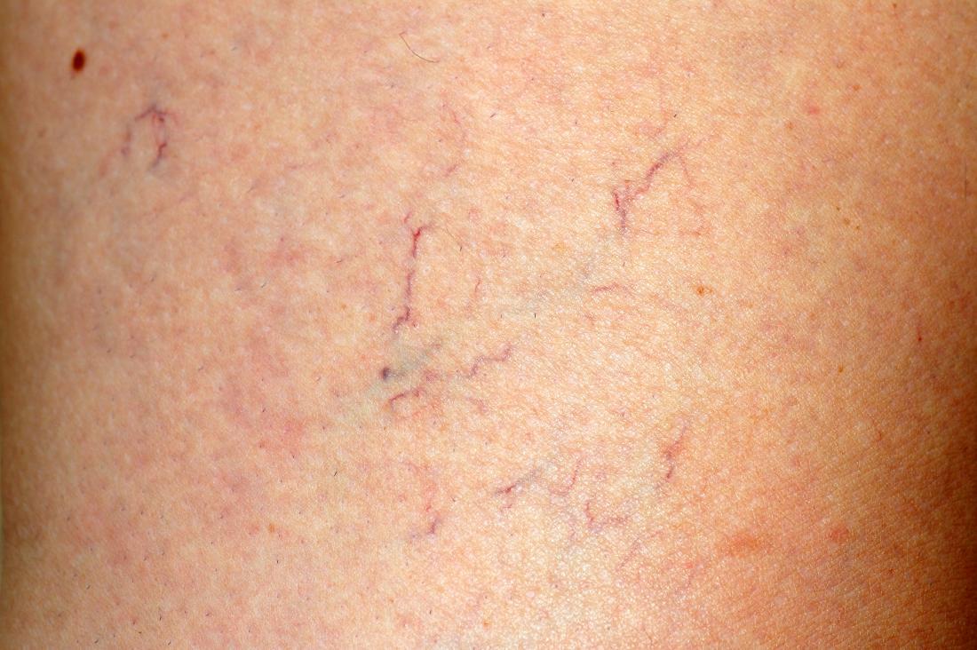 Spider vein treatment2