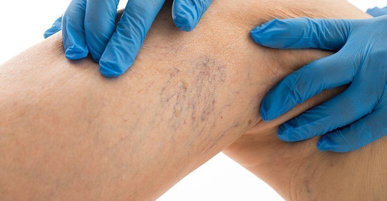 Spider vein treatment3