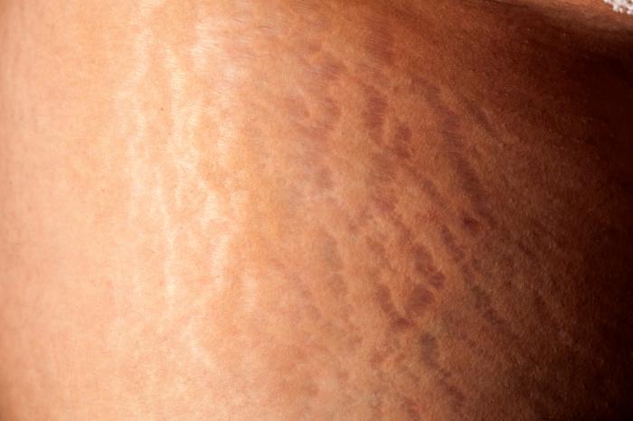 Stretch Mark Treatment