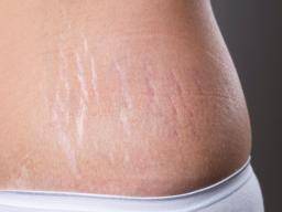 Stretch Mark Treatment1