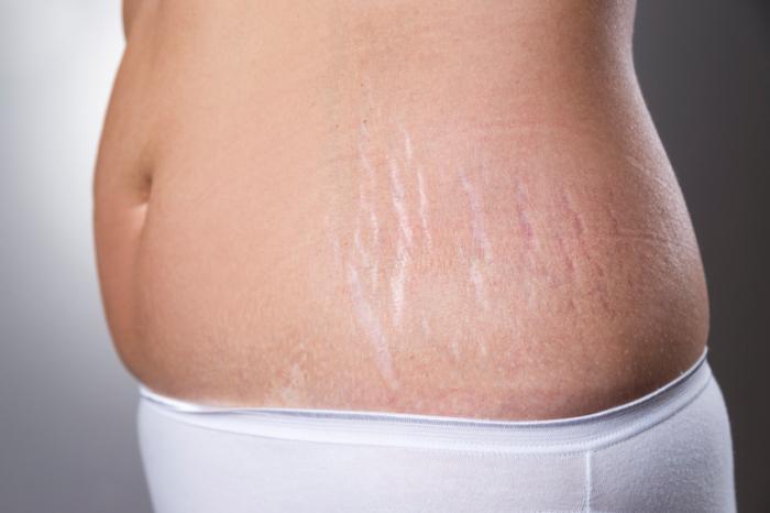 Stretch Mark Treatment2